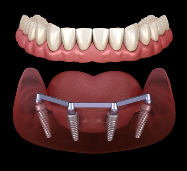 Single Tooth Implant in Lakeway, TX
