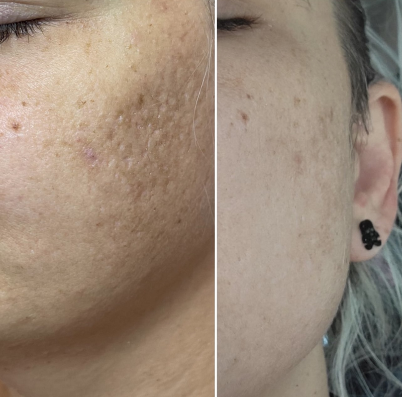 Skin Treatment Before and After Charlottesville VA Med Spa
