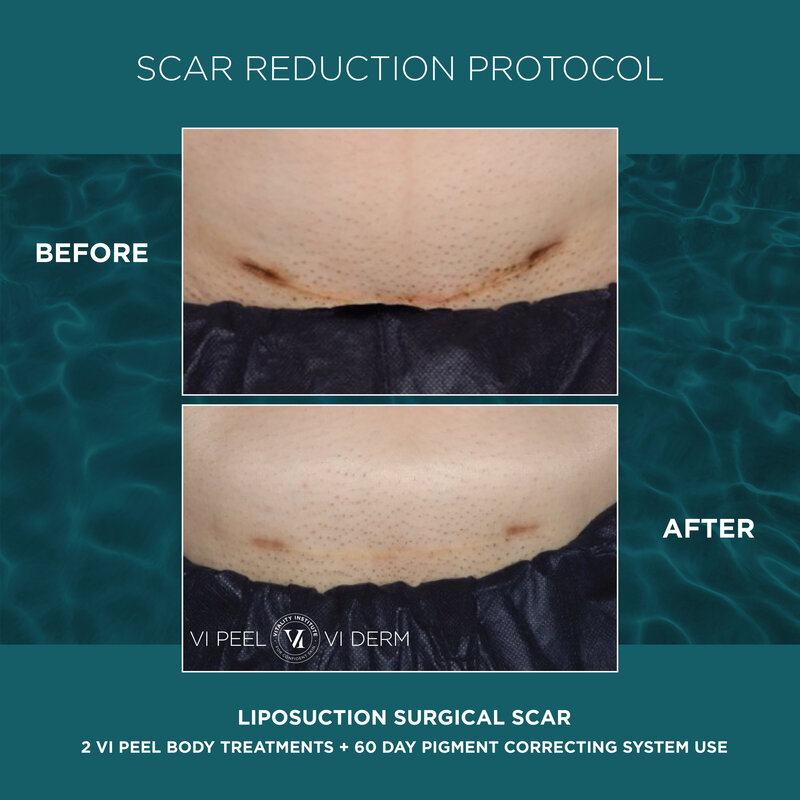 A_Scar Reduction Protocol_Lipo Surgical Scar_2 Peel 60 Day PCK_GRAPHIC