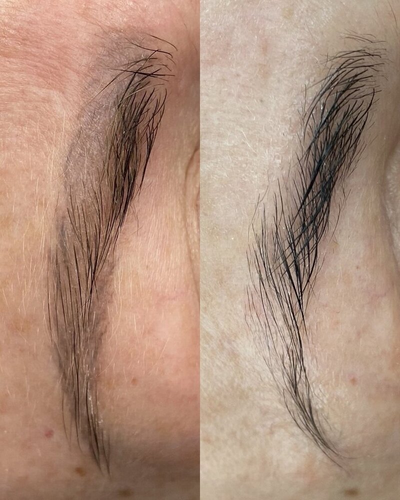 Laser eyebrows removal