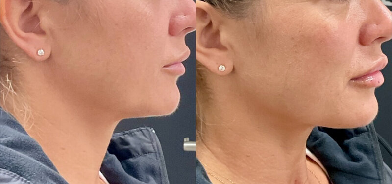 Dermal fillers provide a versatile, age-appropriate solution for those looking to restore or enhance features in their face. By adding balance and restoring lost facial volume, these cosmetic injectables allow individuals of all ages the chance to look their best with minimal effort. Whatever your skin concern, our experts at Bellezza Moderna Aesthetics can help. We offer safe, effective dermal filler treatments to clients in the Lakes Region of New Hampshire.