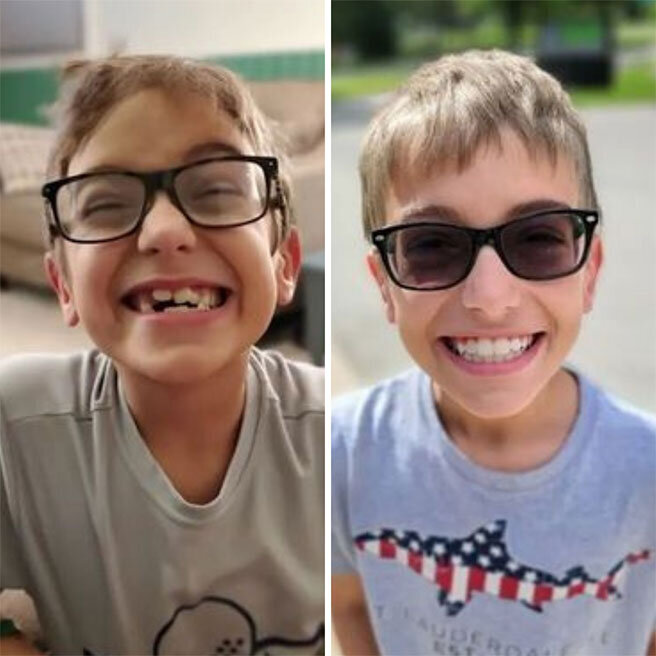 invisalign-before-after4