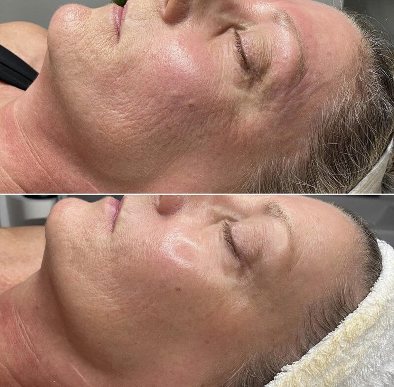 Needling