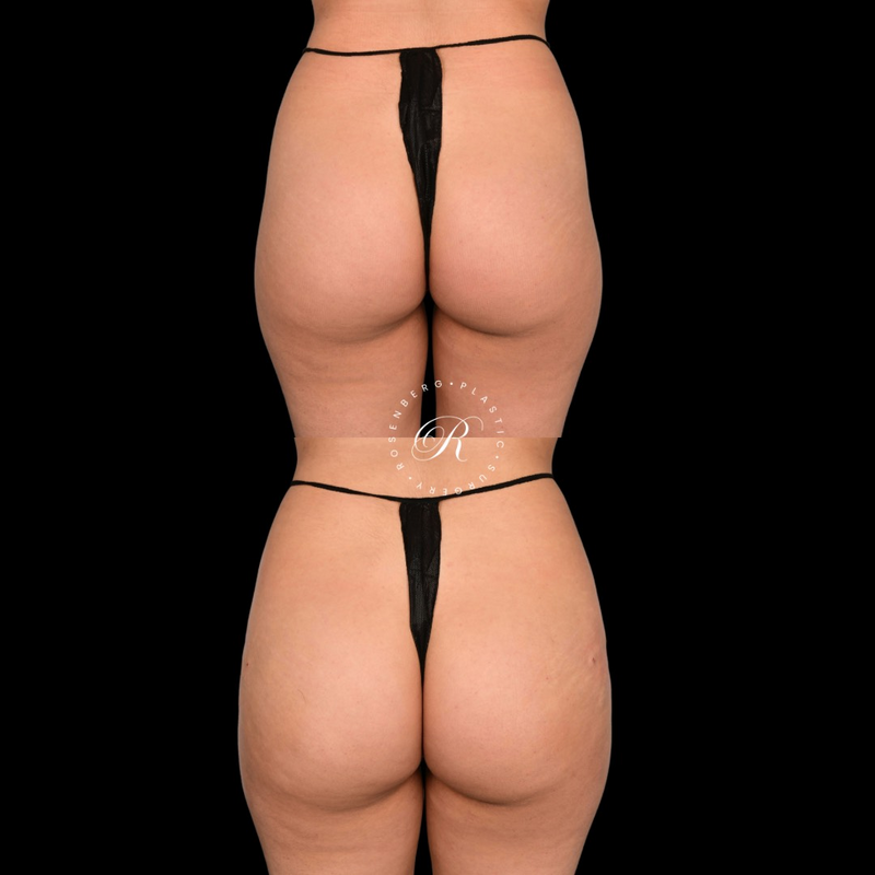 BeverlyBum Before and After