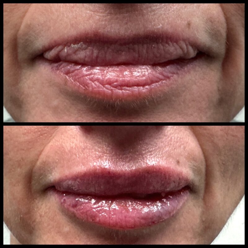 Filler before and after on the lips