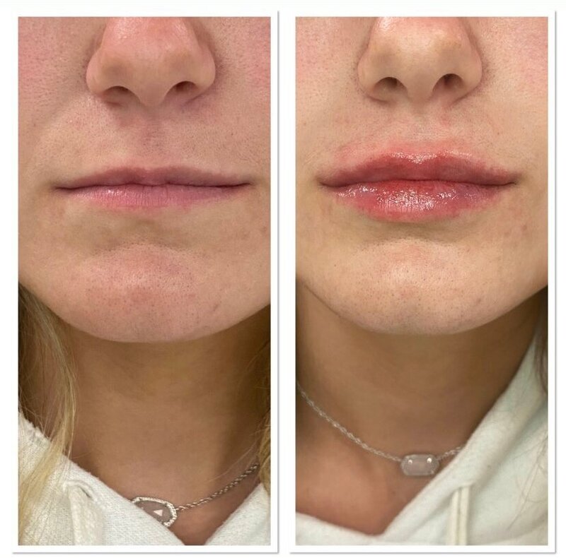 Beauty and Grace Aesthetics Restalyne Kysse patient before and after