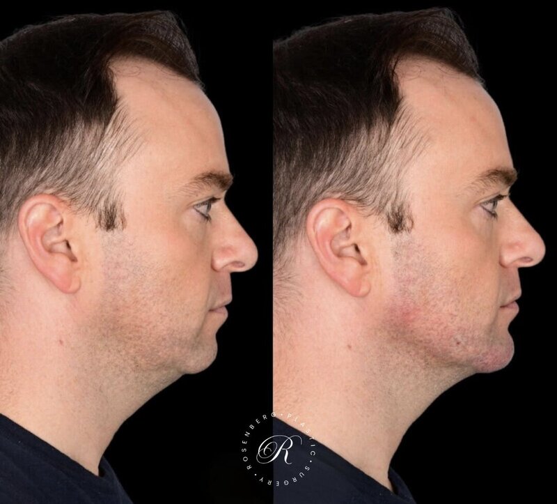 Non-surgical ChinJaw Augmentation RPS Before & After.zip - 40