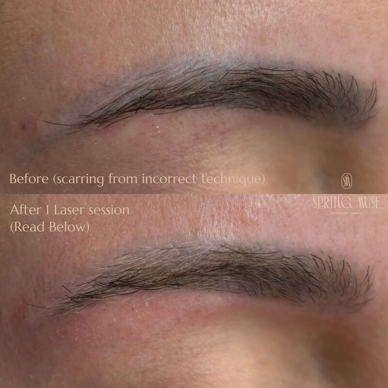 Laser microblading removal NYC