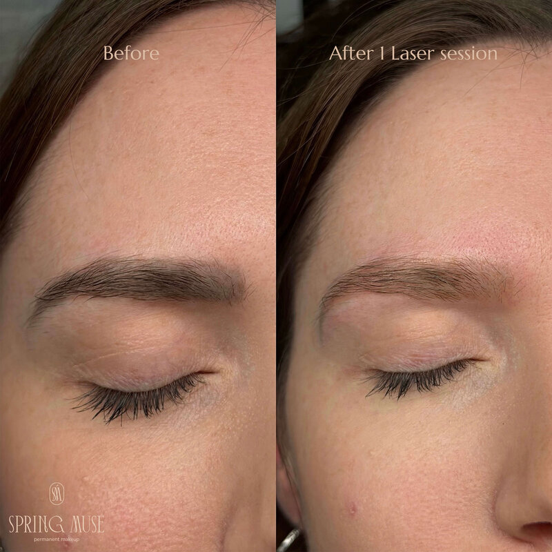 Laser Eyebrows Removal New York