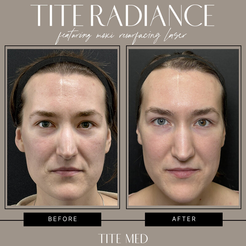 TITE-BEFOREAFTER copy 3
