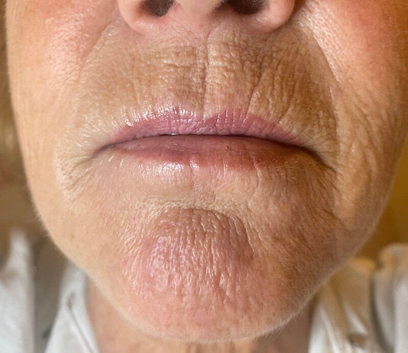 carbonpeel soins esthétique