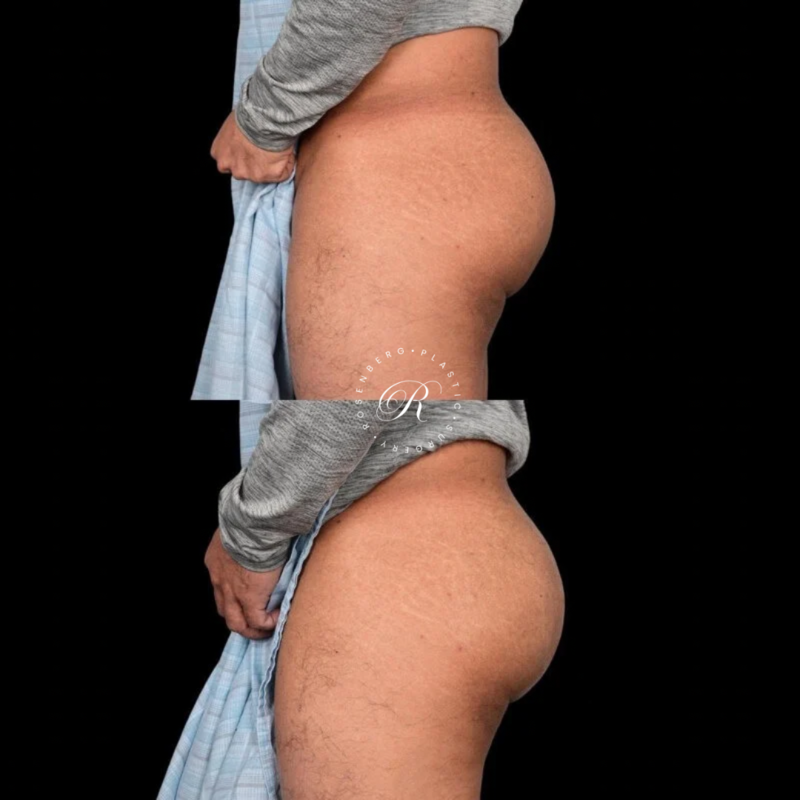 BeverlyBum RPS Before & Afters - 4