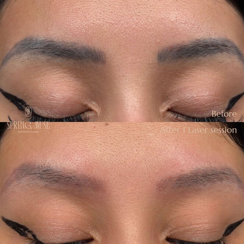 Laser Eyebrows Removal New York