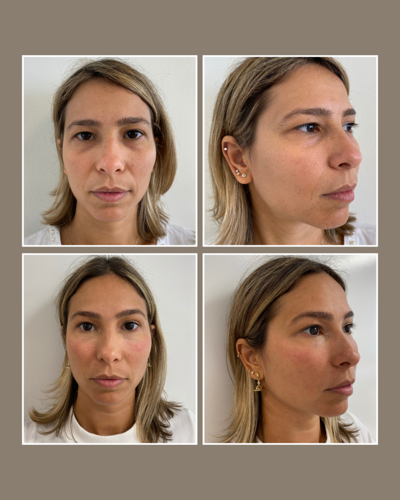 Injectables - Glösense Dermatology and Aesthetics, Miami