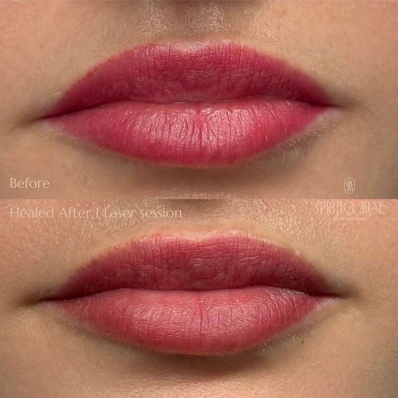 Lip Blush laser removal NYC