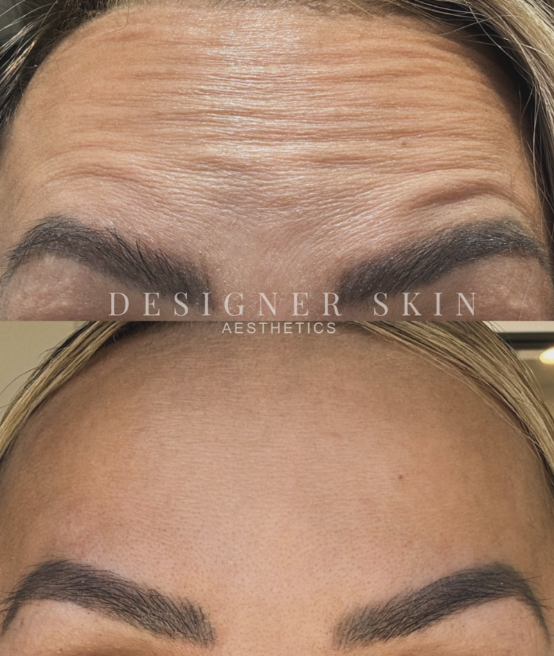 Forehead wrinkle reduction with Botox in Orange County