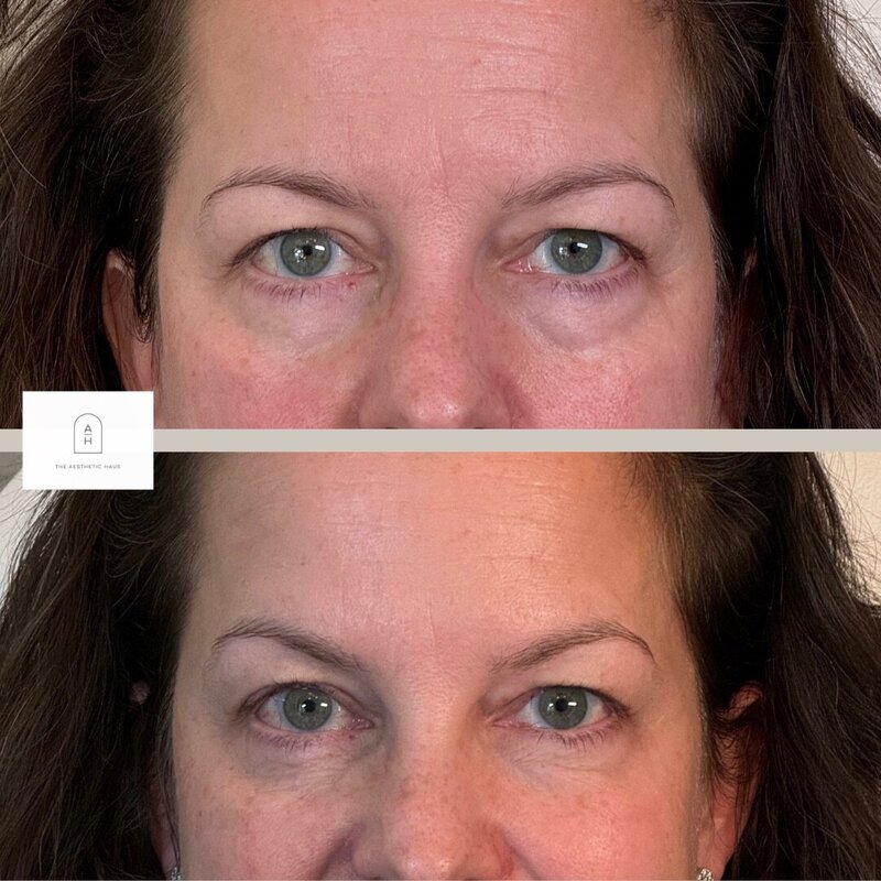Botox 2