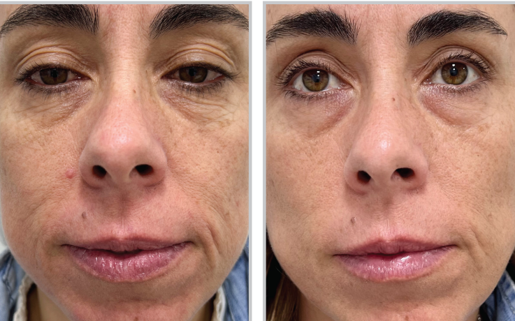 Before and after ClearSilk™: smoother, clearer, and more radiant skin