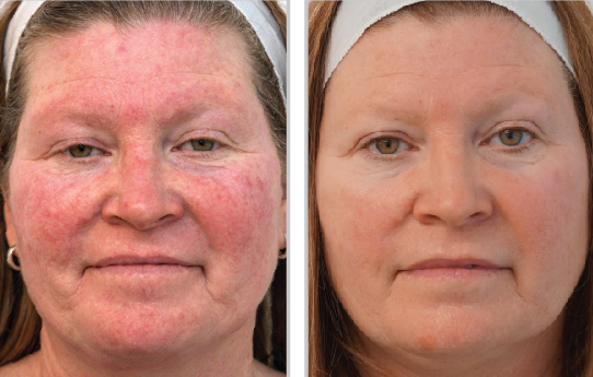 Comparison of skin before and after two BBL® HEROic™ broadband light laser facials, revealing smoother texture and a radiant glow.