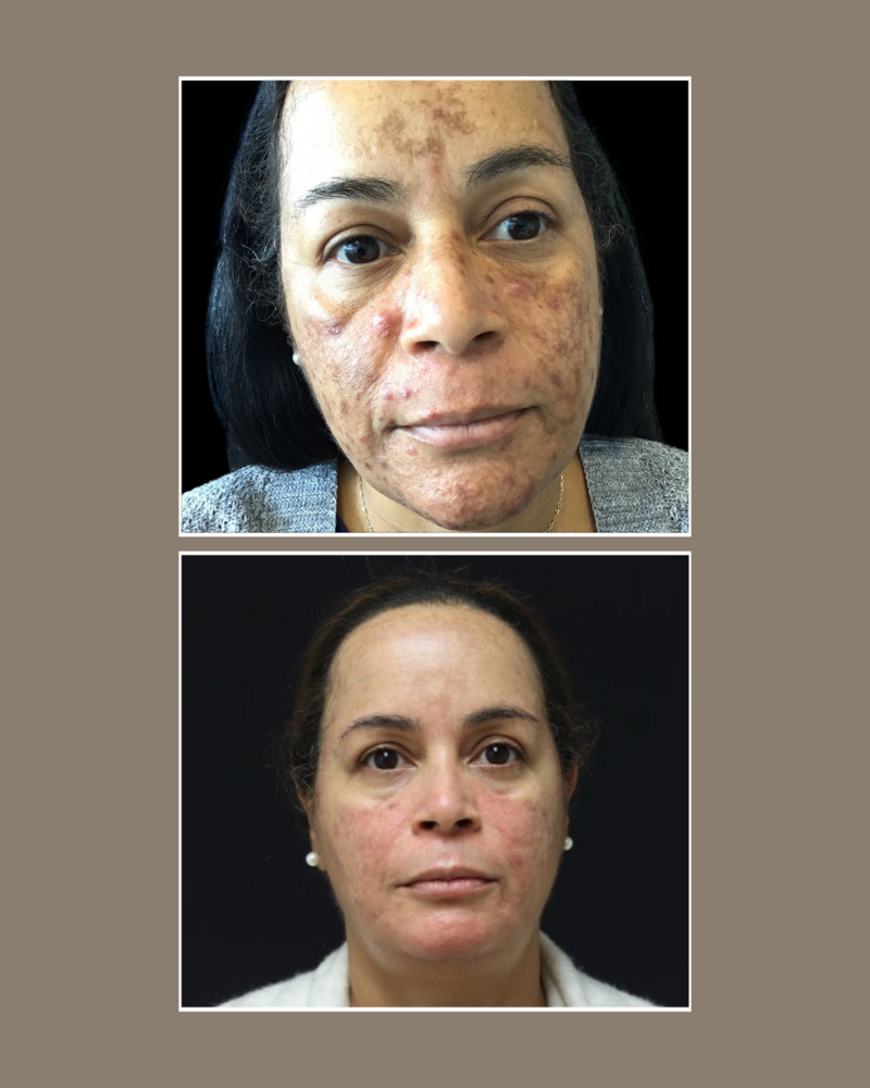 Skin Concerns - Glösense Dermatology and Aesthetics, Miami