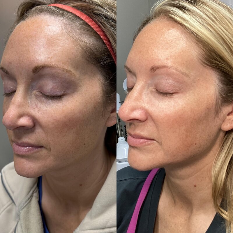 Before and after photos of a woman with Sculptra