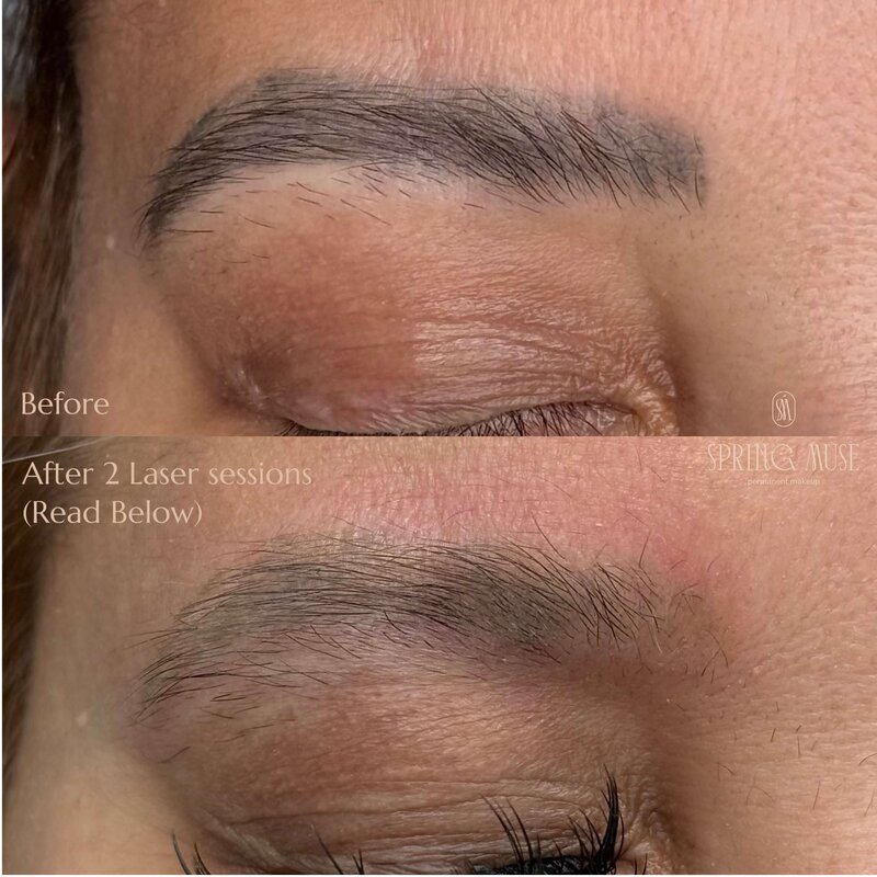 Laser microblading removal NYC