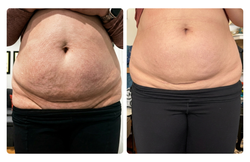 Lauren, 21 months versus 25 months post-Cesarean