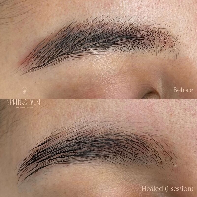 Laser microblading removal NYC