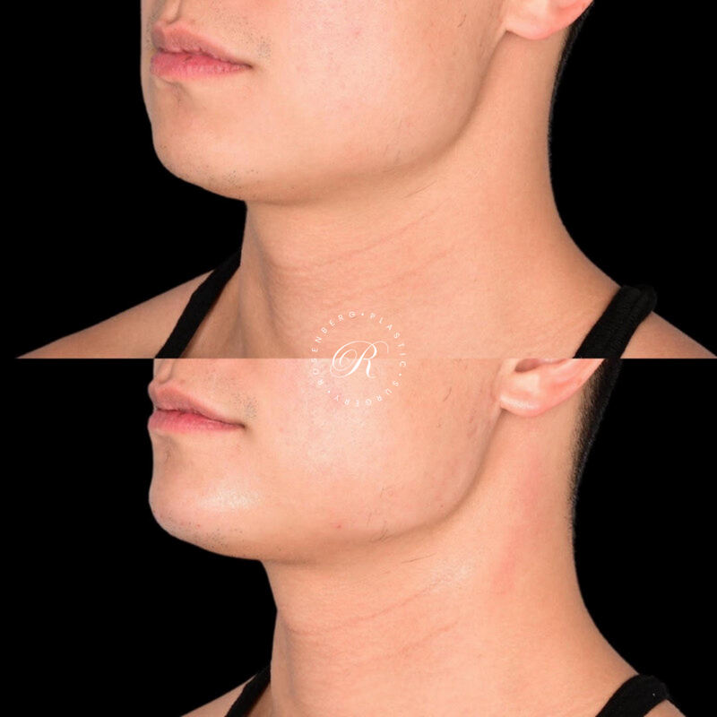 Non-surgical ChinJaw Augmentation RPS Before & After.zip - 42