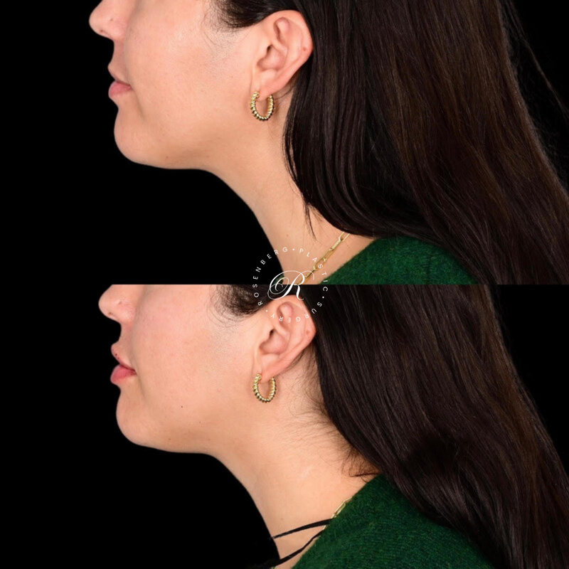 Non-surgical Lip Augmentation RPS Before & Afters.zip - 8