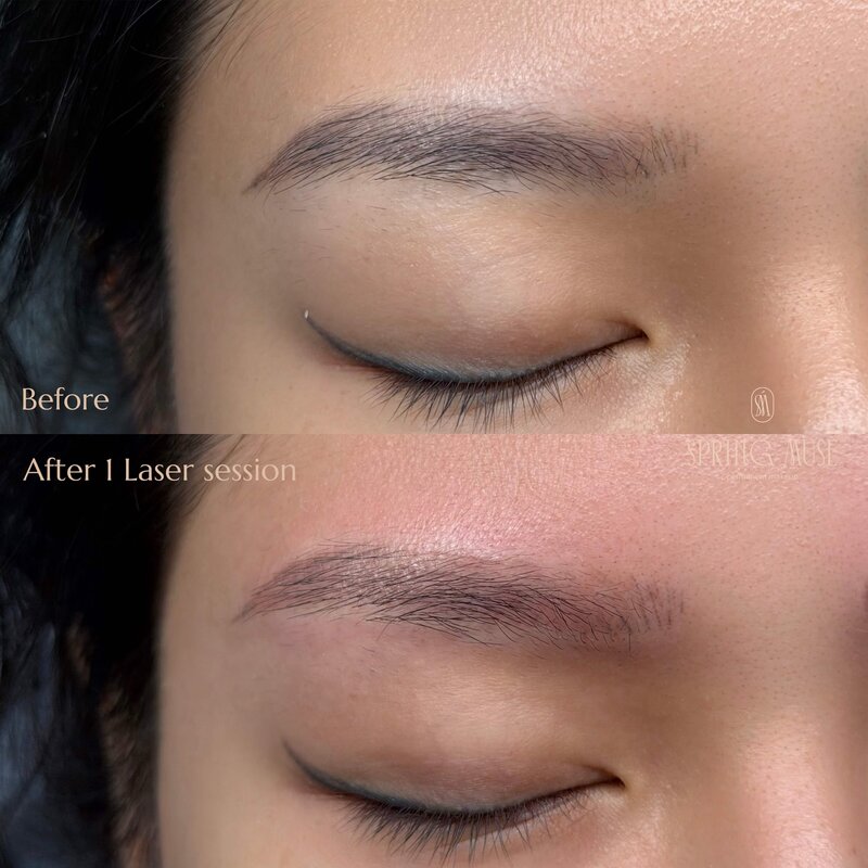 Laser Eyebrows Removal New York
