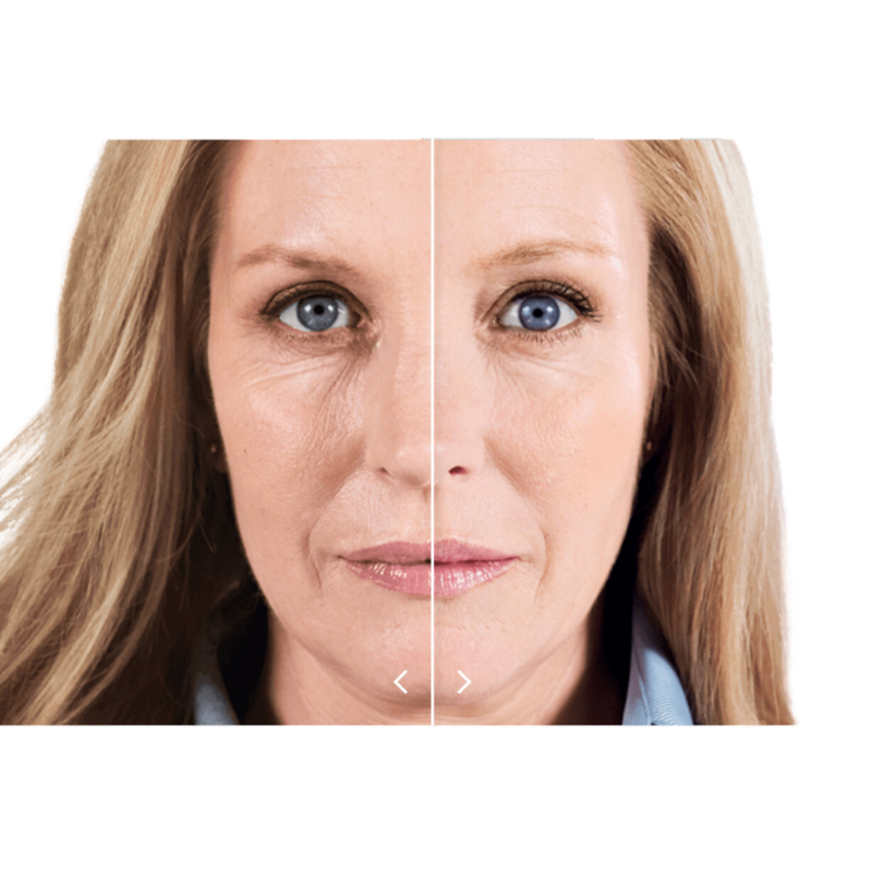 skinpen alone (3)