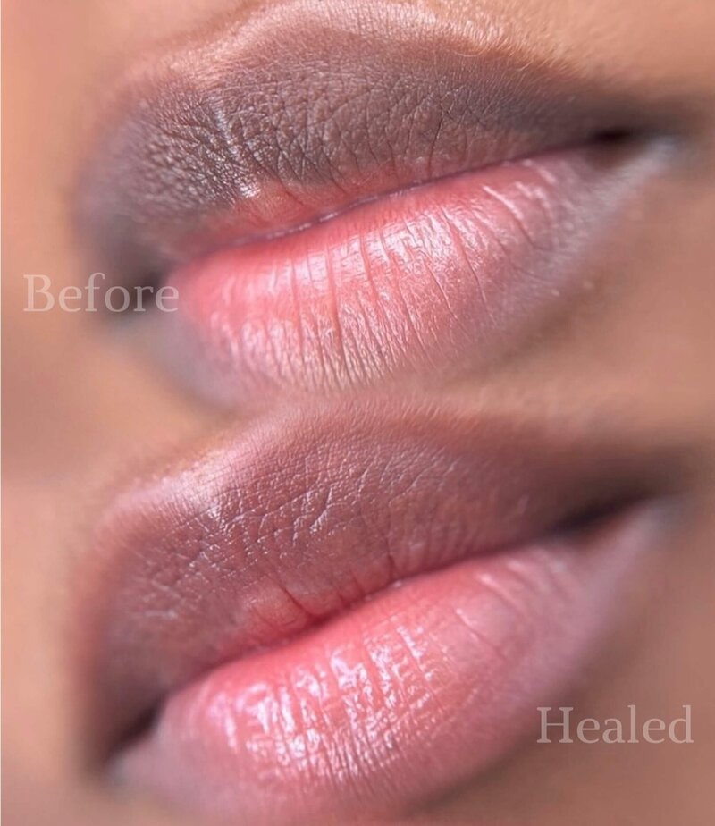 Healed Lip Neutralization New York