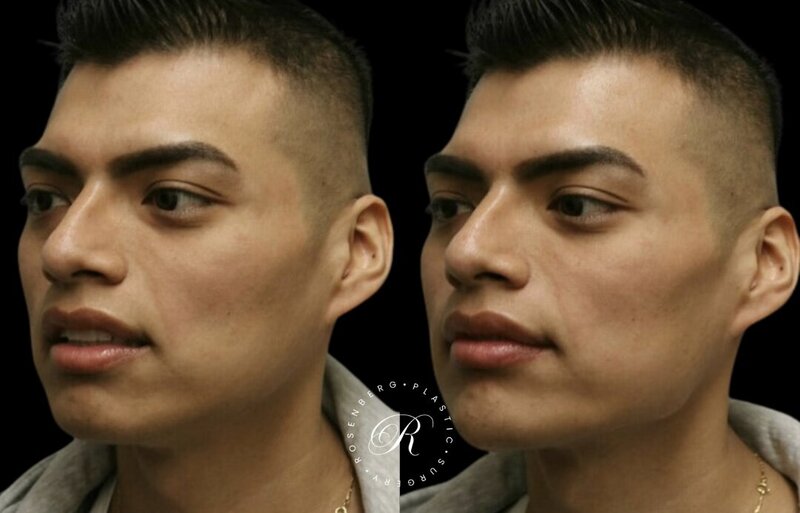 Non-surgical ChinJaw Augmentation RPS Before & After.zip - 2