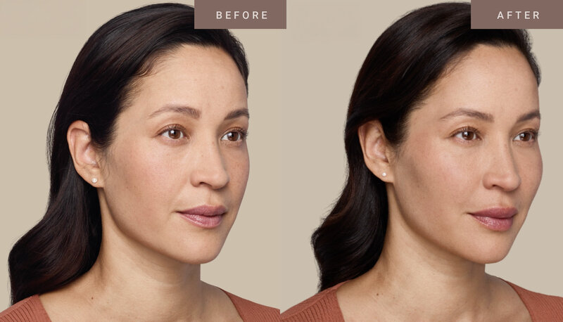 Juvederm_BA