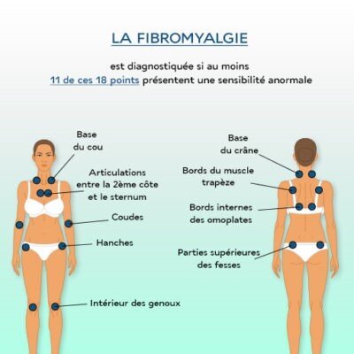 fibromyalgie