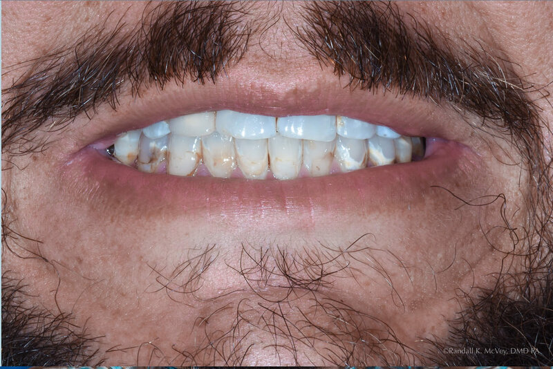 Example 1-A photo of  a patient's before VENEERS & CROWNS