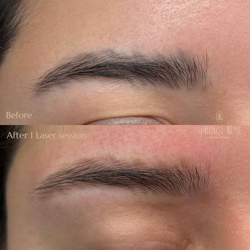 Laser Eyebrows Removal New York