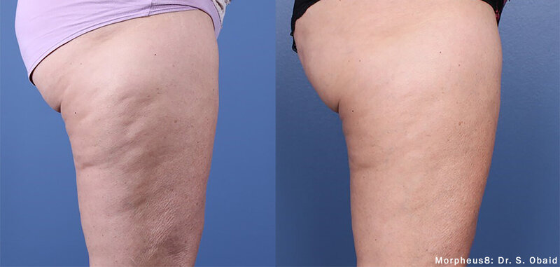 Morpheus8_Before&After (2)