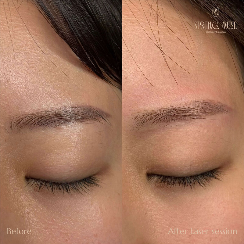 Laser Eyebrows Removal New York