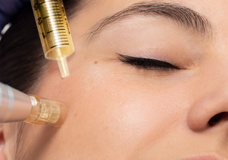 Woman getting her face microneedled with PRF for collagen boosting