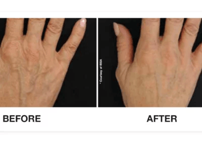 Profhilo-before-and-after-hands-for-main-page.-I-would-like-to-get-the-keywords-treatment-for-ageing-hands-or-more-400x284