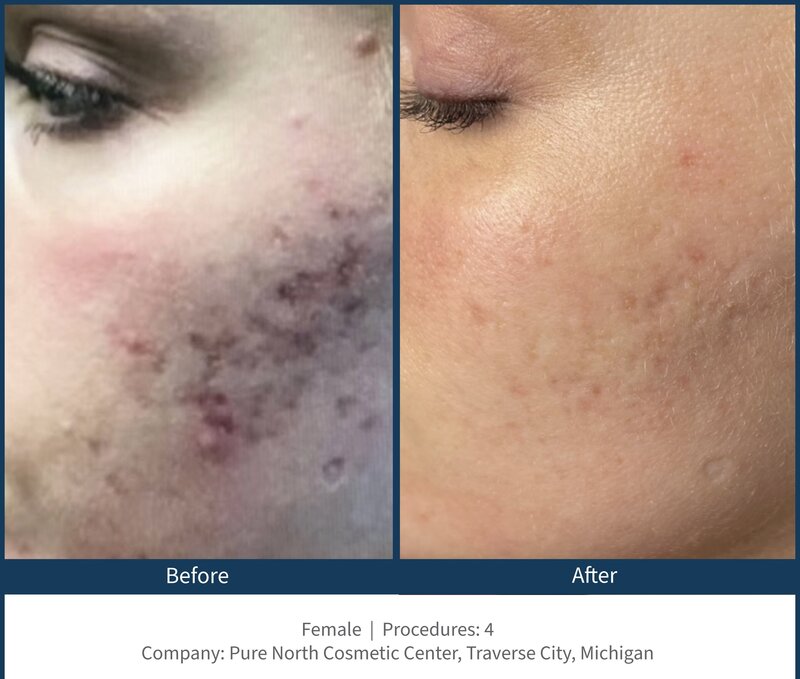 BA Acne Scar 4 treatment_scale_100_quality_100_embedMetadata_true_contentETag_2_embedColorProfile_true