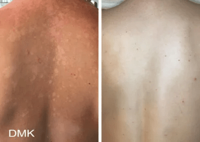 DMK-pigmentation-and-sun-damage-on-back-400x284
