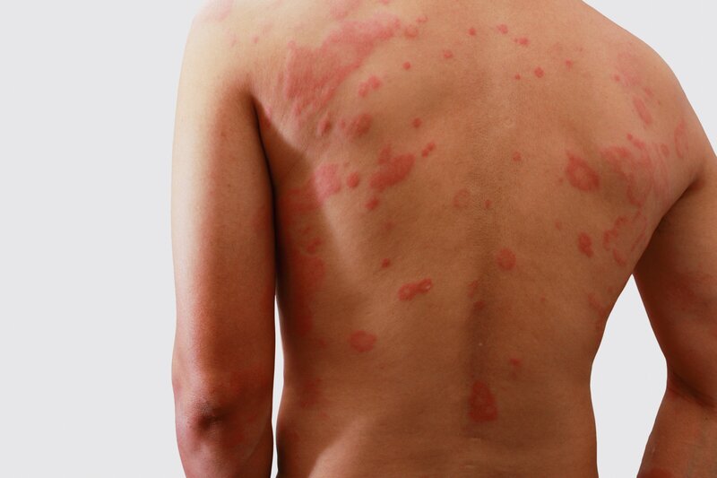 naked back with red irritated skin patches of dermatitis