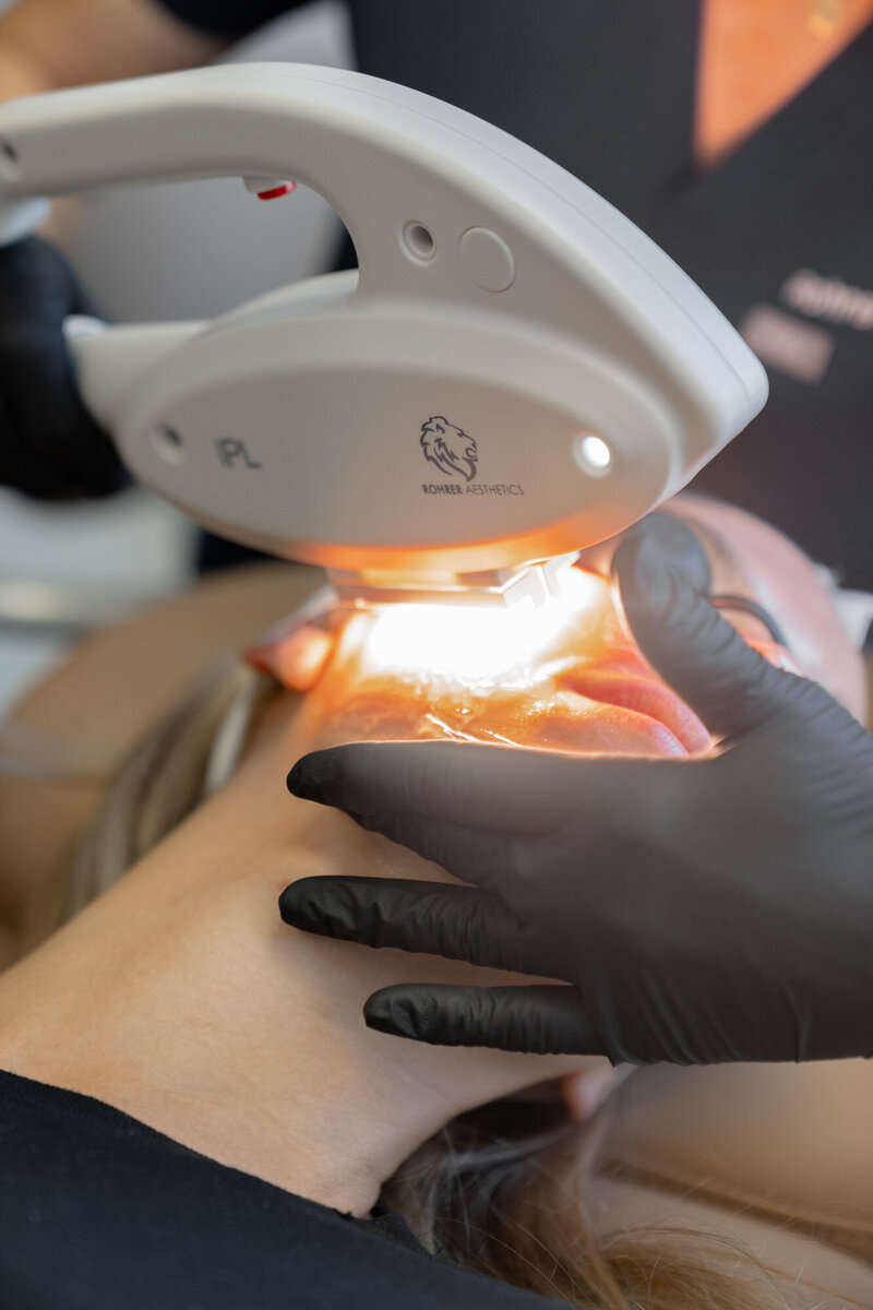 Close-up of an IPL treatment in progress, showcasing advanced laser skin resurfacing Charleston techniques to improve skin tone and texture.