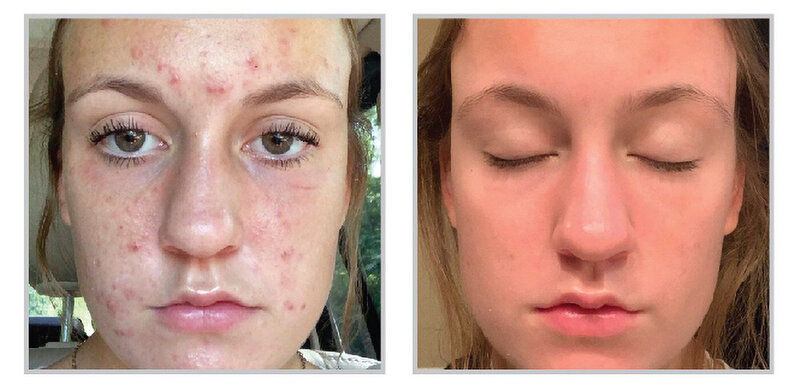 Beauty and Grace Aesthetics Botox patient before and after