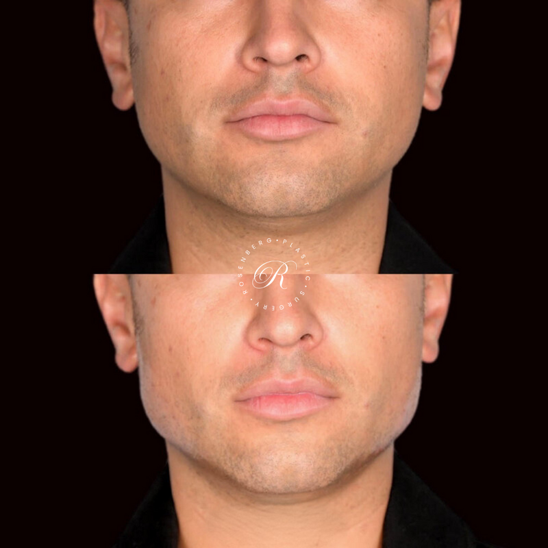 Non-surgical ChinJaw Augmentation RPS Before & After.zip - 44