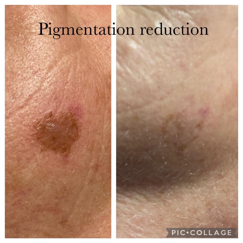 skin correcting treatments in Norwich Norfolk