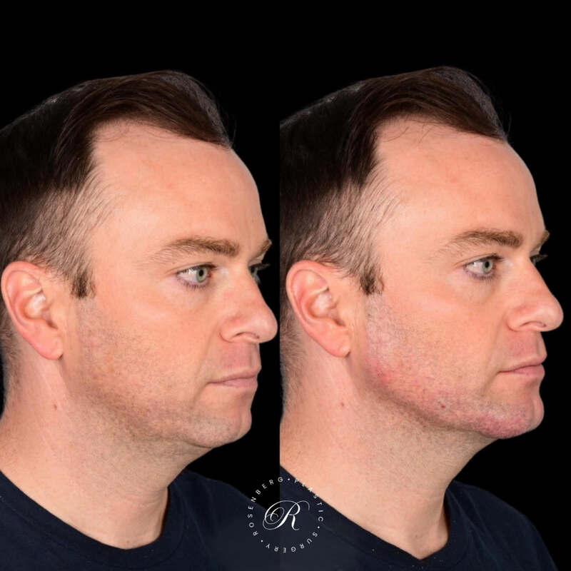 Non-surgical ChinJaw Augmentation RPS Before & After.zip - 32